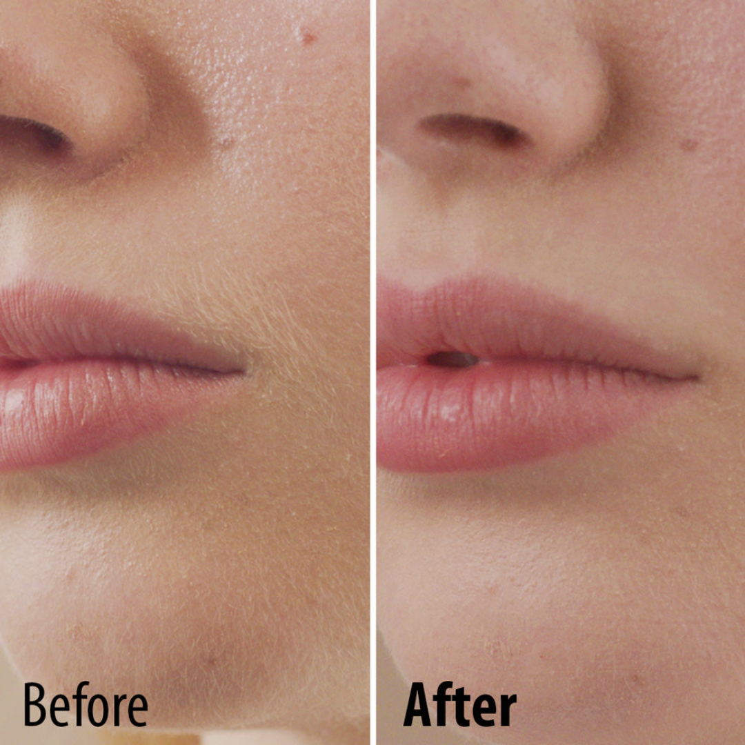 Thin Lizzy Perfect Face Hair Remover (Recharge)